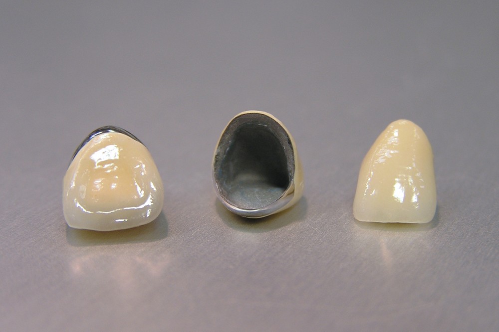 自費メタルボンドクラウン