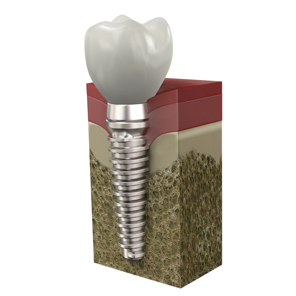 セメント固定式